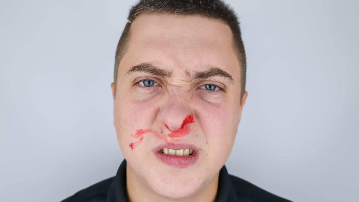 Um homem com o nariz sangrando. 