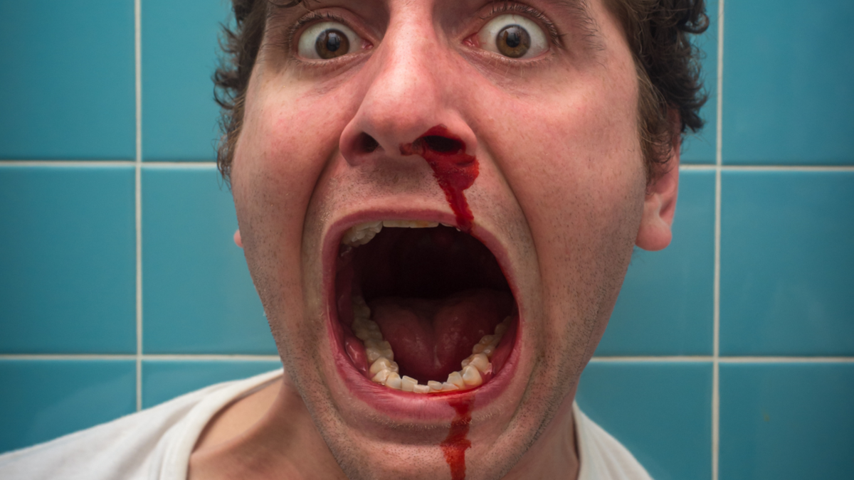 Um homem com o nariz sangrando. 