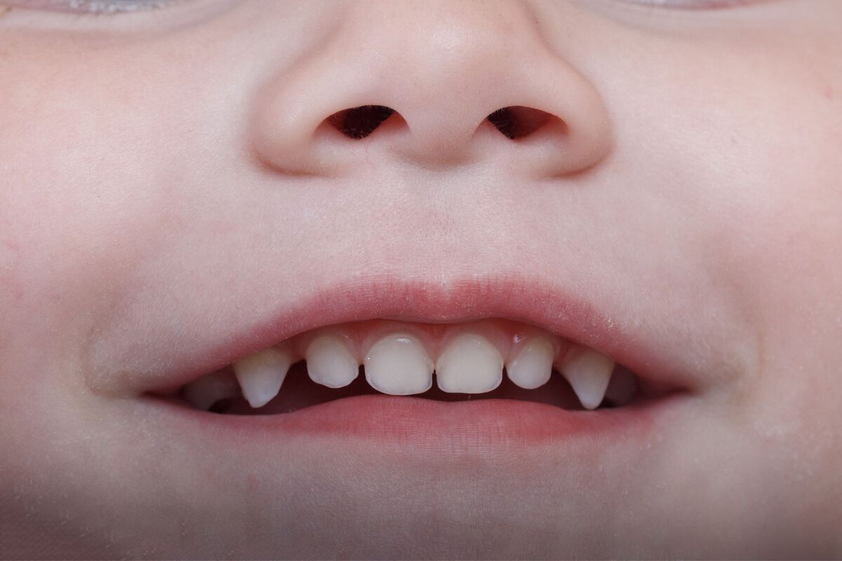 Criança mostrando os dentes.