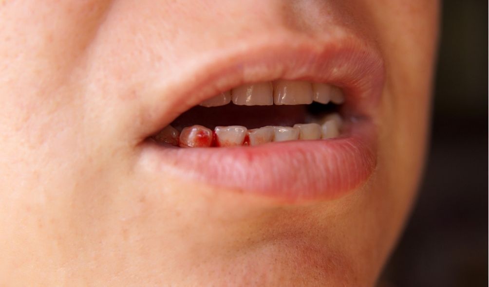 Homem com dente sangrando