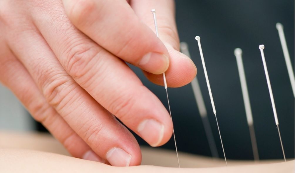 Aplicação de acupuntura