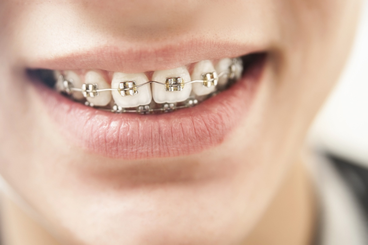 Boca de pessoa usando aparelho, simbolizando dente mole com aparelho.