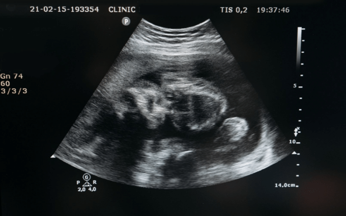Ultrassonografia mostrando feto morto em sonho