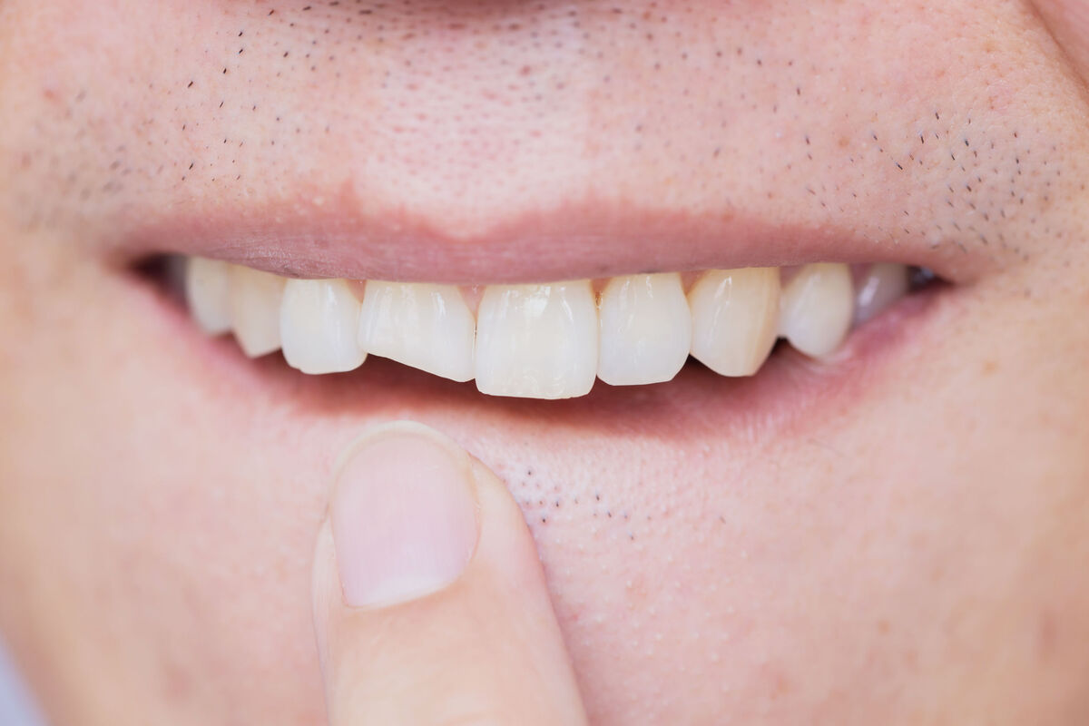 Homem mostrando dente da frente quebrado