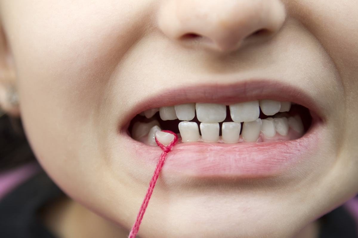 Criança arrancando dente mole com linha