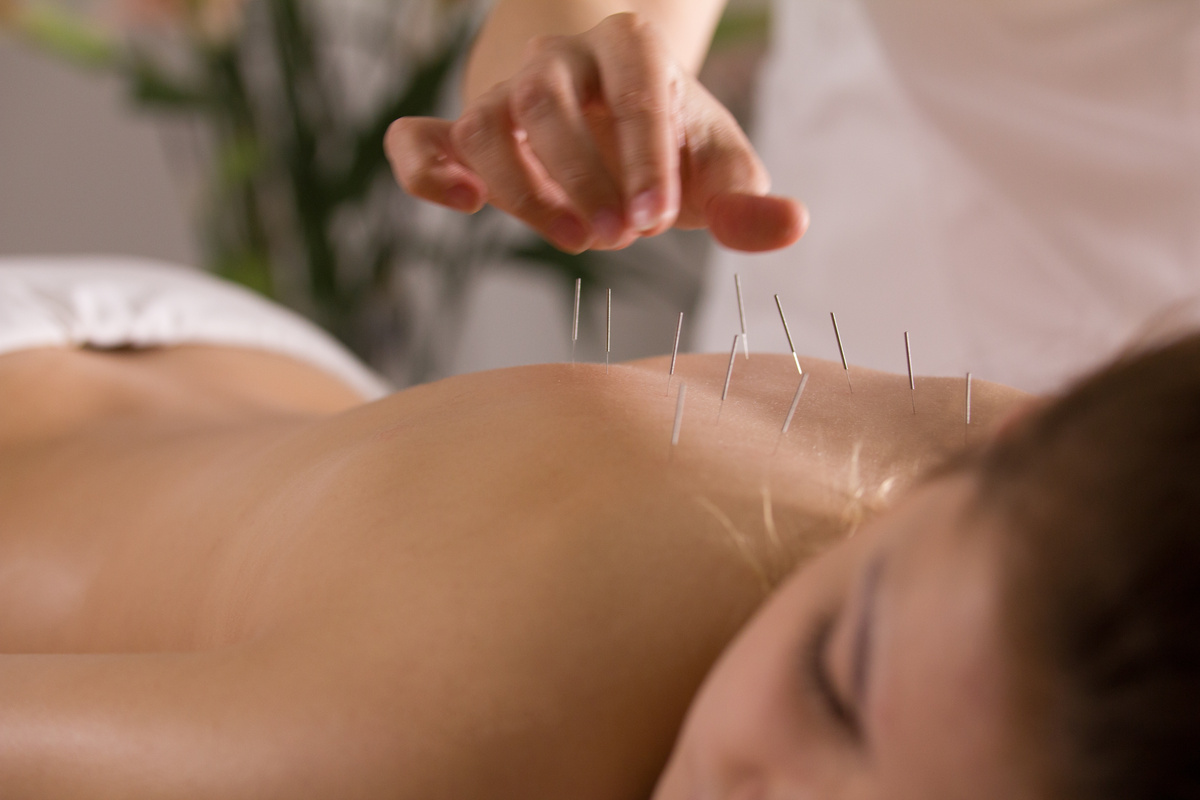 Mulher fazendo acupuntura. 