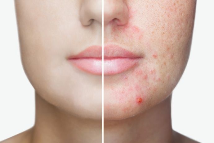 Rosto com divisão ao meio mostrando um lado com acne e outro lado do rosto sem acne