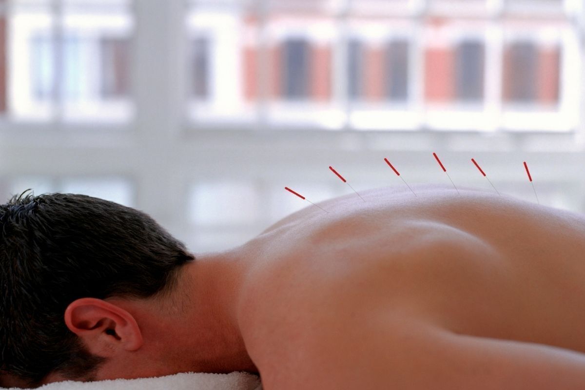 Homem em sessão de acupuntura com agulhas nas costas.