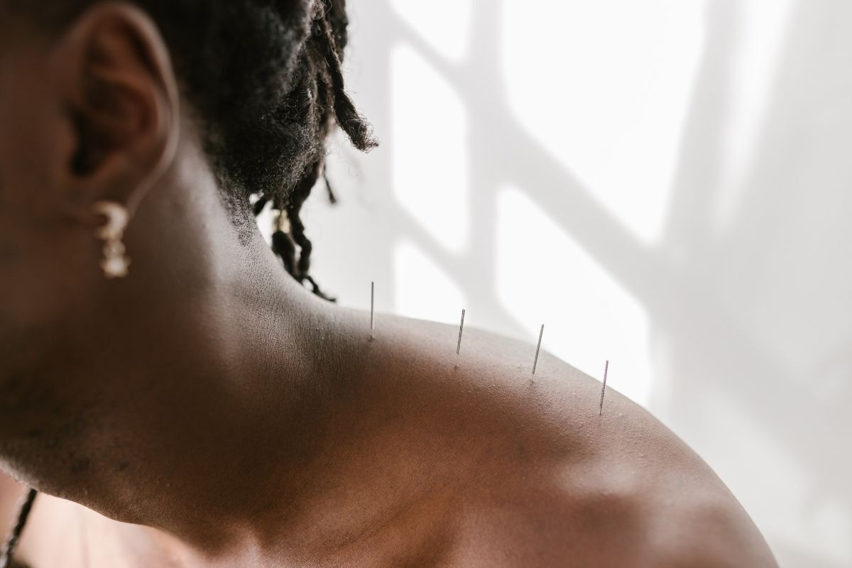 Homem com agulhas de acupuntura na pele.