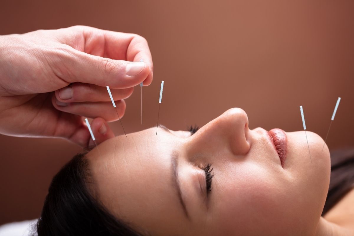 Mulher com agulhas de acupuntura no rosto.
