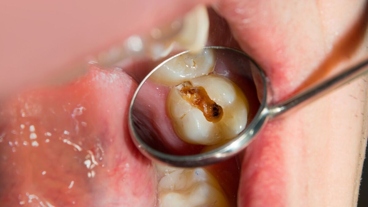 Dentista tirando um dente com buraco.
