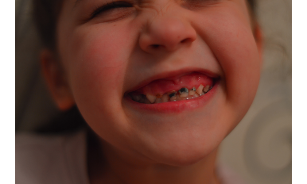 Criança sorrindo com os dentes podres.