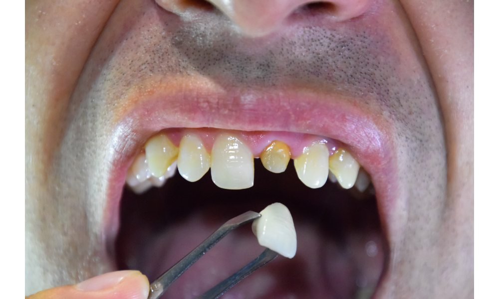 Homem mostrando dente podre e colocando um implante dentário no local.
