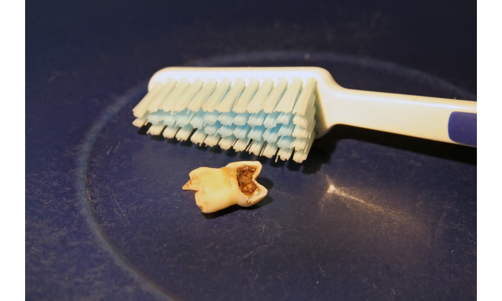 Escova de dentes ao lado de um dente podre apoiado em uma mesa.