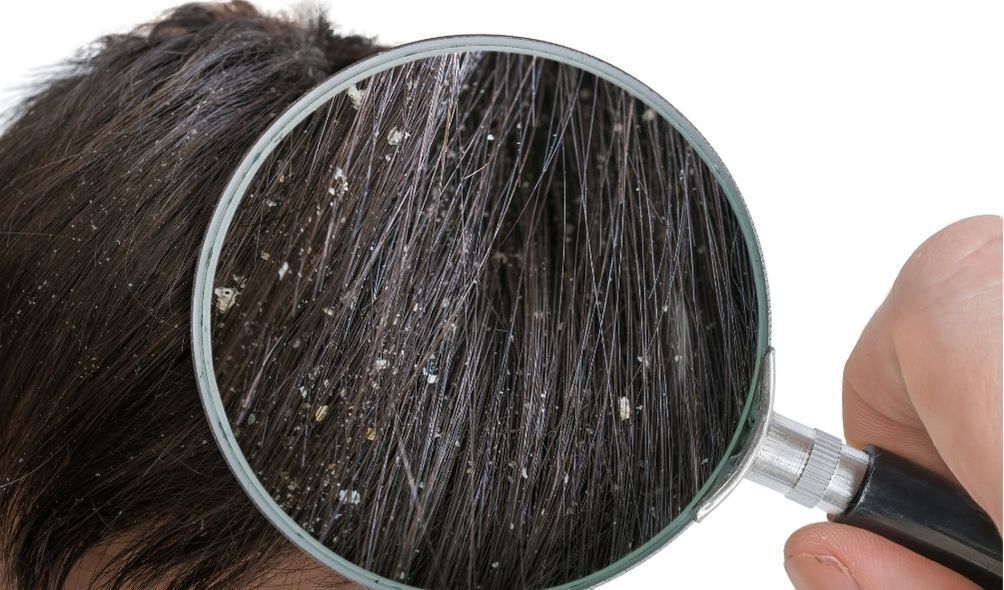 Caspa no cabelo de uma pessoa sendo analisada por uma lupa